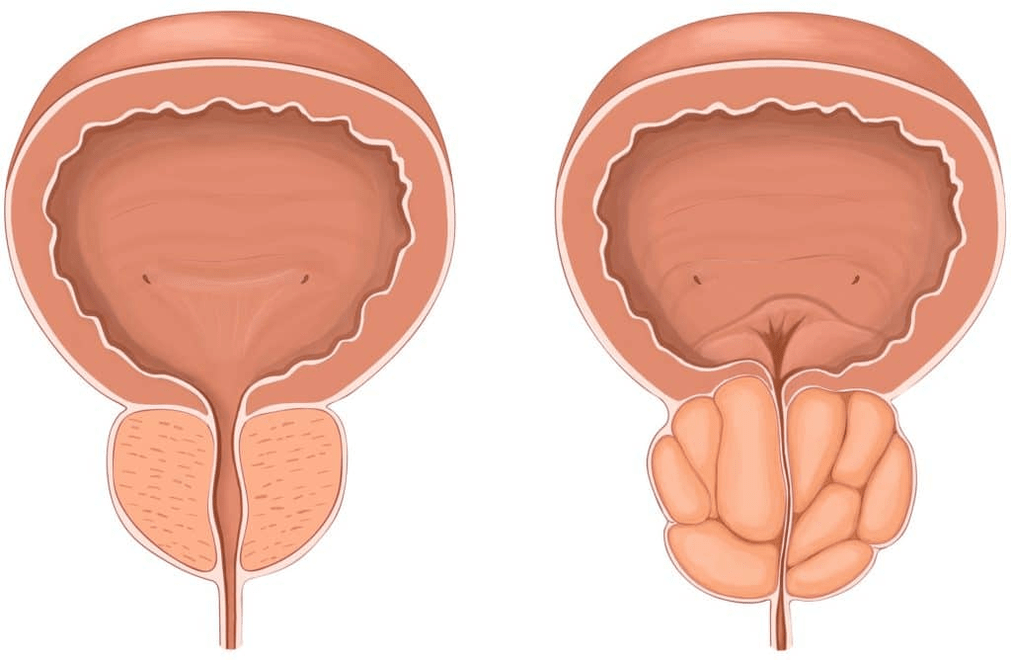 Ce se întâmplă cu prostata în timpul prostatitei