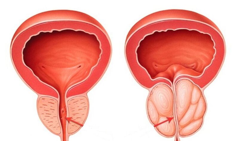 Prostată sănătoasă și inflamată cu prostatită